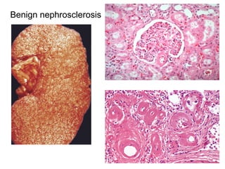Benign nephrosclerosis
 