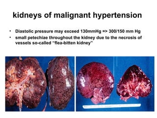 kidneys of malignant hypertension
• Diastolic pressure may exceed 130mmHg => 300/150 mm Hg
• small petechiae throughout the kidney due to the necrosis of
vessels so-called “flea-bitten kidney”
 