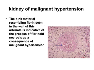 kidney of malignant hypertension
• The pink material
resembling fibrin seen
in the wall of this
arteriole is indicative of
the process of fibrinoid
necrosis as a
consequence of
malignant hypertension
 