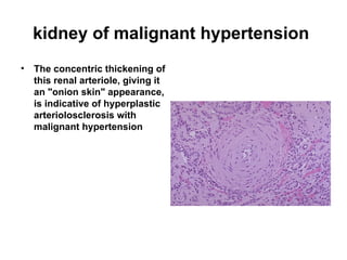 kidney of malignant hypertension
• The concentric thickening of
this renal arteriole, giving it
an "onion skin" appearance,
is indicative of hyperplastic
arteriolosclerosis with
malignant hypertension
 