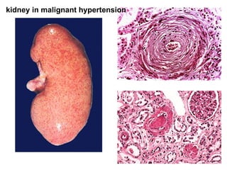 kidney in malignant hypertension
 