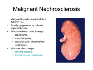 Malignant Nephrosclerosis
• Malignant hypertension (diastolic >
130 mm Hg).
• Rapidly progressive, accelerated
nephrosclerosis.
• Affects the heart, brain, kidneys:
– papilledema.
– encephalopathy.
– cardiovascular. abnormalities
– renal failure.
• Microvascular changes:
– fibrinoid necrosis.
– smooth muscle proliferation.
 