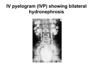 IV pyelogram (IVP) showing bilateral
hydronephrosis
 