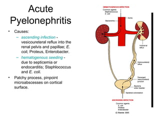 Acute
Pyelonephritis
• Causes:
– ascending infection -
vesicoureteral reflux into the
renal pelvis and papillae; E.
coli, Proteus, Enterobacter.
– hematogenous seeding -
due to septicemia or
endocarditis; Staphlococcus
and E. coli.
• Patchy process, pinpoint
microabscesses on cortical
surface.
 