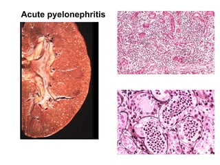 Acute pyelonephritis
 
