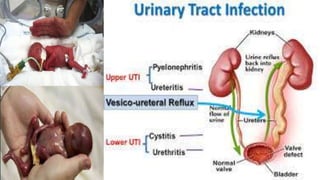 Urinary tract infection | PPTX