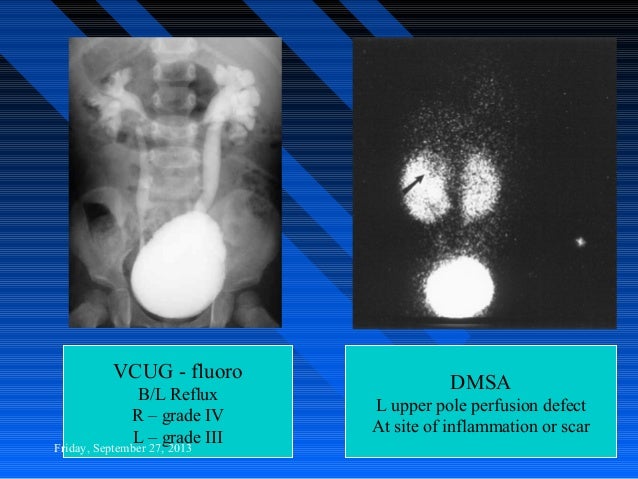 post void residual urine in female post void residual urine in female