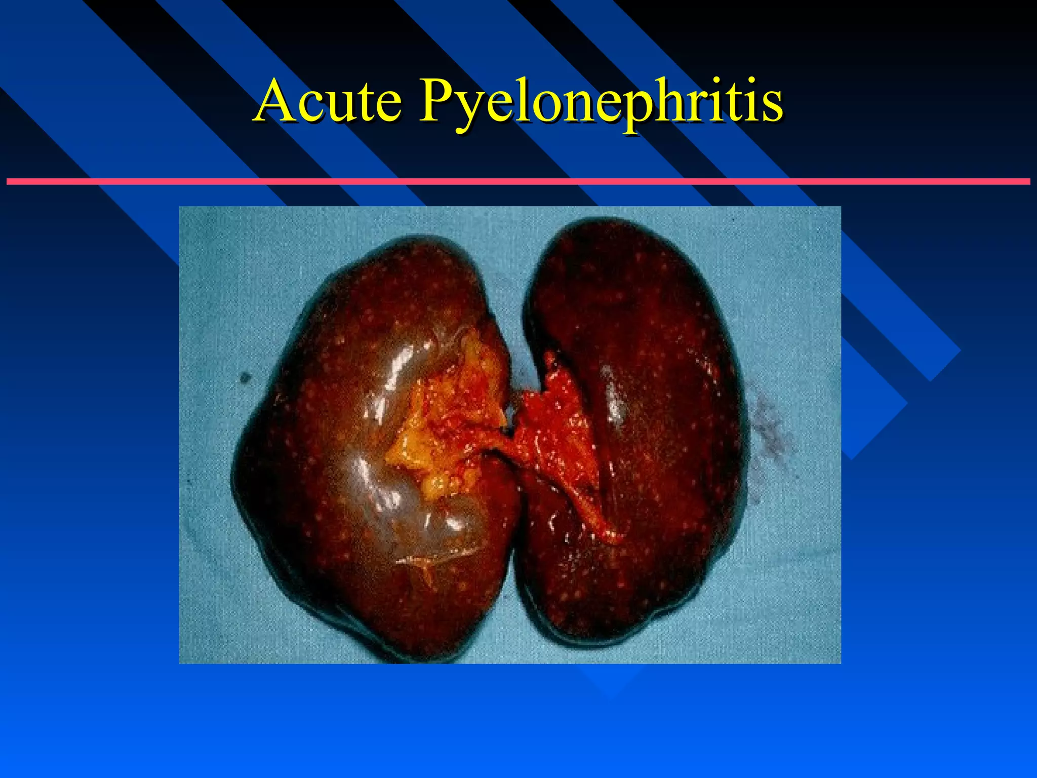 Acute Pyelonephritis

 