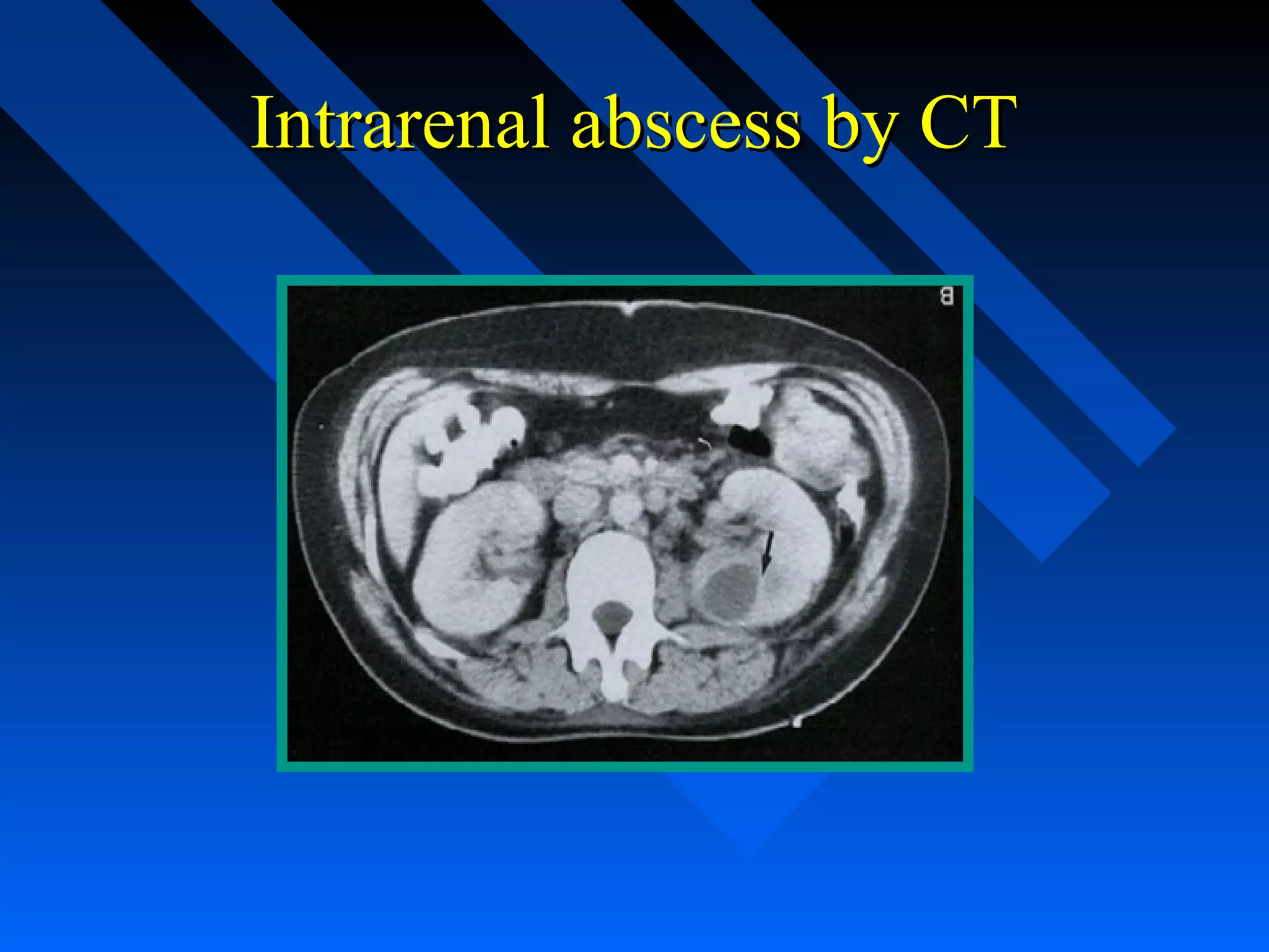 Intrarenal abscess by CT

 