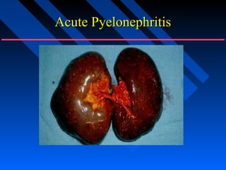 Acute Pyelonephritis

 