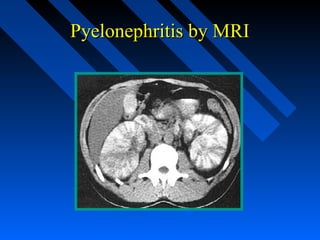 Pyelonephritis by MRI

 