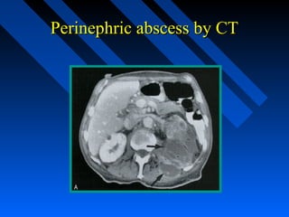 Perinephric abscess by CT

 