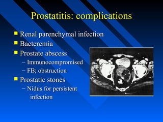 Prostatitis: complications
Renal parenchymal infection
 Bacteremia
 Prostate abscess


– Immunocompromised
– FB; obstruction


Prostatic stones
– Nidus for persistent
infection

 