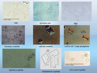WBC Epithelial cells RBC
Tyrosine crystals calcium oxalate "coffin-lid" triple phosphate
Uric acid crystals
Cholesterol crystals
Cystine crystals
 