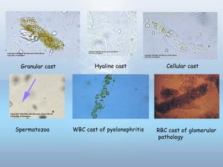 Hyaline castGranular cast Cellular cast
RBC cast of glomerular
pathology
Spermatozoa WBC cast of pyelonephritis
 