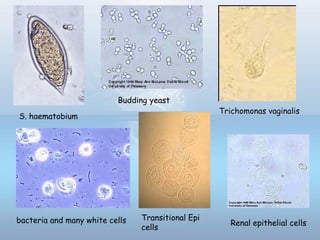 S. haematobium
Budding yeast
bacteria and many white cells
Trichomonas vaginalis
Renal epithelial cells
Transitional Epi
cells
 