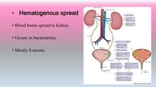 • Hematogenous spread
• Blood borne spread to kidney.
• Occurs in bacteraemia.
• Mostly S.aureus.
 