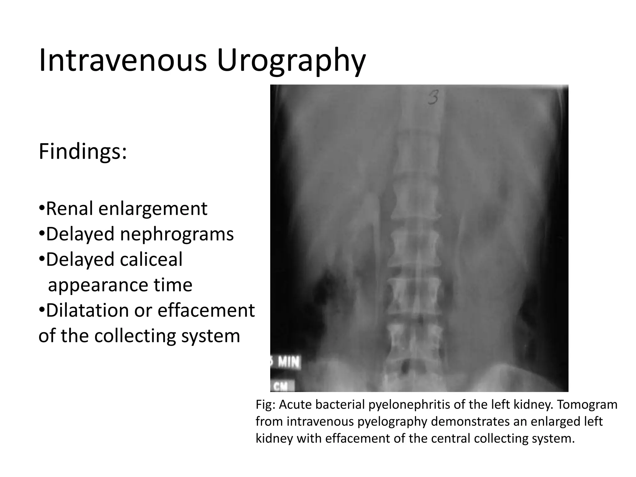 Urinary tract infections | PPTX