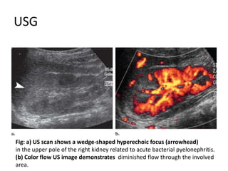 USG
Fig: a) US scan shows a wedge-shaped hyperechoic focus (arrowhead)
in the upper pole of the right kidney related to acute bacterial pyelonephritis.
(b) Color flow US image demonstrates diminished flow through the involved
area.
 