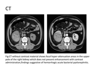 CT
Fig:CT without contrast material shows focal hyper-attenuation areas in the upper
pole of the right kidney which does not present enhancement with contrast
administration,findings suggestive of hemorrhagic acute bacterial pyelonephritis.
 