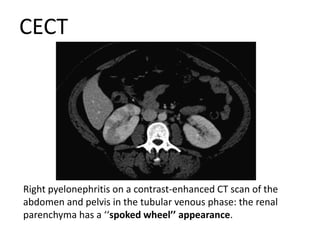 CECT
Right pyelonephritis on a contrast-enhanced CT scan of the
abdomen and pelvis in the tubular venous phase: the renal
parenchyma has a ‘‘spoked wheel’’ appearance.
 
