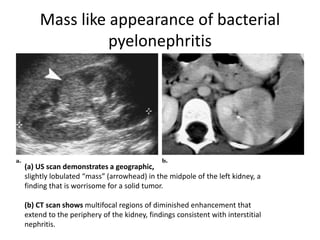 Mass like appearance of bacterial
pyelonephritis
(a) US scan demonstrates a geographic,
slightly lobulated “mass” (arrowhead) in the midpole of the left kidney, a
finding that is worrisome for a solid tumor.
(b) CT scan shows multifocal regions of diminished enhancement that
extend to the periphery of the kidney, findings consistent with interstitial
nephritis.
 