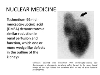 NUCLEAR MEDICINE
Scintiscan obtained with technetium 99m di-mercapto-succinic acid
:Demonstrates a photopenic, peripheral defect (arrow) in the upper lateral
margin of the right kidney that correlates with an area of acute bacterial
pyelonephritis.
Technetium-99m di-
mercapto-succinic acid
(DMSA) demonstrates a
similar reduction in
renal perfusion and
function, which one or
more wedge like defects
in the outline of the
kidneys .
 
