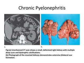 Chronic Pyelonephritis
Fig:(a) Unenhanced CT scan shows a small, deformed right kidney with multiple
deep scars and dystrophic calcifications.
(b) Photograph of the resected kidneys demonstrates extensive bilateral scar
formation.
 