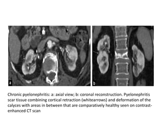Chronic pyelonephritis: a: axial view; b: coronal reconstruction. Pyelonephritis
scar tissue combining cortical retraction (whitearrows) and deformation of the
calyces with areas in between that are comparatively healthy seen on contrast-
enhanced CT scan
 