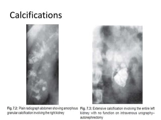 Calcifications
 