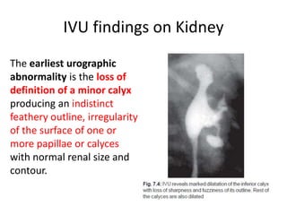IVU findings on Kidney
The earliest urographic
abnormality is the loss of
definition of a minor calyx
producing an indistinct
feathery outline, irregularity
of the surface of one or
more papillae or calyces
with normal renal size and
contour.
 