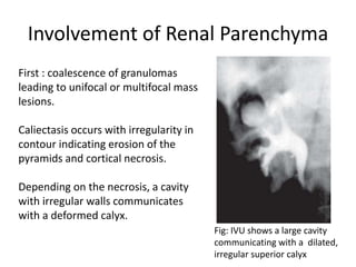 Involvement of Renal Parenchyma
Fig: IVU shows a large cavity
communicating with a dilated,
irregular superior calyx
First : coalescence of granulomas
leading to unifocal or multifocal mass
lesions.
Caliectasis occurs with irregularity in
contour indicating erosion of the
pyramids and cortical necrosis.
Depending on the necrosis, a cavity
with irregular walls communicates
with a deformed calyx.
 