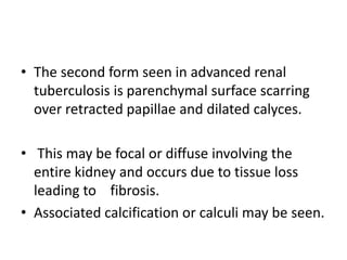 • The second form seen in advanced renal
tuberculosis is parenchymal surface scarring
over retracted papillae and dilated calyces.
• This may be focal or diffuse involving the
entire kidney and occurs due to tissue loss
leading to fibrosis.
• Associated calcification or calculi may be seen.
 