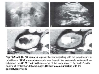 Figs 7.6A to D: (A) IVU reveals a large cavity communicating with the superior calyx of
right kidney, (B) US shows a hypoechoic focal lesion in the upper polar cortex with an
echogenic rim, (C) CT confirms the presence of the cavity seen on IVU and US, with
pooling of contrast on delayed images, (D) due to communication with the
pelvicalyceal system
 
