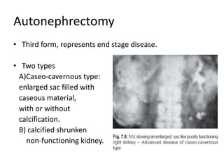 Autonephrectomy
• Third form, represents end stage disease.
• Two types
A)Caseo-cavernous type:
enlarged sac filled with
caseous material,
with or without
calcification.
B) calcified shrunken
non-functioning kidney.
 