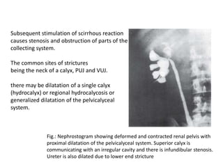 Fig.: Nephrostogram showing deformed and contracted renal pelvis with
proximal dilatation of the pelvicalyceal system. Superior calyx is
communicating with an irregular cavity and there is infundibular stenosis.
Ureter is also dilated due to lower end stricture
Subsequent stimulation of scirrhous reaction
causes stenosis and obstruction of parts of the
collecting system.
The common sites of strictures
being the neck of a calyx, PUJ and VUJ.
there may be dilatation of a single calyx
(hydrocalyx) or regional hydrocalycosis or
generalized dilatation of the pelvicalyceal
system.
 