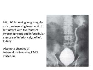 Fig.: IVU showing long irregular
stricture involving lower end of
left ureter with hydroureter,
Hydronephrosis and infundibular
stenosis of inferior calyx of left
kidney.
Also note changes of
tuberculosis involving L2-L3
vertebrae
 