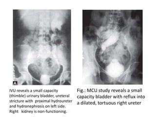Fig.: MCU study reveals a small
capacity bladder with reflux into
a dilated, tortuous right ureter
IVU reveals a small capacity
(thimble) urinary bladder, ureteral
stricture with proximal hydroureter
and hydronephrosis on left side.
Right kidney is non-functioning.
 