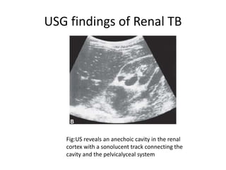 USG findings of Renal TB
Fig:US reveals an anechoic cavity in the renal
cortex with a sonolucent track connecting the
cavity and the pelvicalyceal system
 