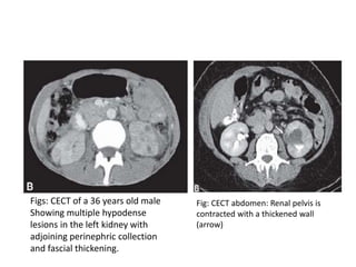 Figs: CECT of a 36 years old male
Showing multiple hypodense
lesions in the left kidney with
adjoining perinephric collection
and fascial thickening.
Fig: CECT abdomen: Renal pelvis is
contracted with a thickened wall
(arrow)
 