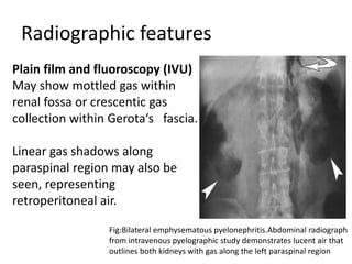 Radiographic features
Plain film and fluoroscopy (IVU)
May show mottled gas within
renal fossa or crescentic gas
collection within Gerota‘s fascia.
Linear gas shadows along
paraspinal region may also be
seen, representing
retroperitoneal air.
Fig:Bilateral emphysematous pyelonephritis.Abdominal radiograph
from intravenous pyelographic study demonstrates lucent air that
outlines both kidneys with gas along the left paraspinal region
 