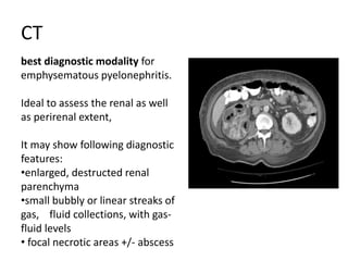 CT
best diagnostic modality for
emphysematous pyelonephritis.
Ideal to assess the renal as well
as perirenal extent,
It may show following diagnostic
features:
•enlarged, destructed renal
parenchyma
•small bubbly or linear streaks of
gas, fluid collections, with gas-
fluid levels
• focal necrotic areas +/- abscess
 