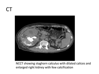 CT
NCCT showing staghorn calculus with dilated calices and
enlarged right kidney with few calcification
 