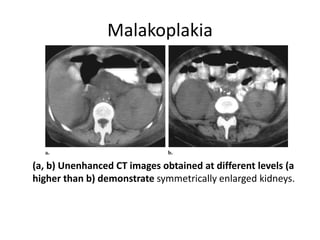 Malakoplakia
(a, b) Unenhanced CT images obtained at different levels (a
higher than b) demonstrate symmetrically enlarged kidneys.
 
