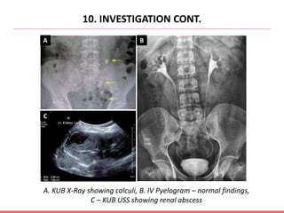 10. INVESTIGATION CONT.
A B
C
A. KUB X-Ray showing calculi, B. IV Pyelogram – normal findings,
C – KUB USS showing renal abscess
 