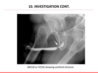 10. INVESTIGATION CONT.
MCUG or VCUG showing urethral stricture
 