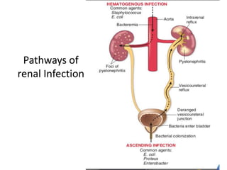 Pathways of
renal Infection
 