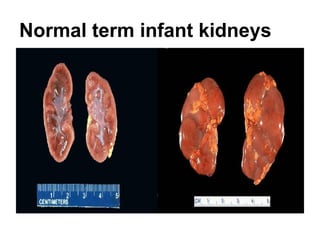 Infant Kidneys Urinary tract pathology lab | PDF