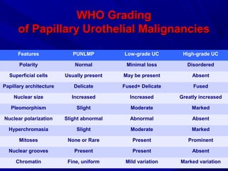 WHO GradingWHO Grading
of Papillary Urothelial Malignanciesof Papillary Urothelial Malignancies
Features PUNLMP Low-grade UC High-grade UC
Polarity Normal Minimal loss Disordered
Superficial cells Usually present May be present Absent
Papillary architecture Delicate Fused+ Delicate Fused
Nuclear size Increased Increased Greatly increased
Pleomorphism Slight Moderate Marked
Nuclear polarization Slight abnormal Abnormal Absent
Hyperchromasia Slight Moderate Marked
Mitoses None or Rare Present Prominent
Nuclear grooves Present Present Absent
Chromatin Fine, uniform Mild variation Marked variation
 