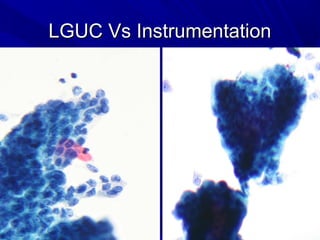 LGUC Vs InstrumentationLGUC Vs Instrumentation
 